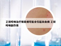 乙双吗啉治疗银屑病可能会引起白血病 乙双吗啉副作用