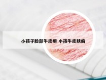 小孩子脸部牛皮癣 小孩牛皮肤癣