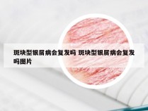 斑块型银屑病会复发吗 斑块型银屑病会复发吗图片