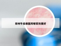 郑州牛皮癣医院哪家效果好