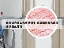 银屑病为什么头屑特别多 银屑病患者头皮屑多该怎么处理