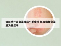 银屑病一定会发展成中重度吗 银屑病都会发展为重症吗
