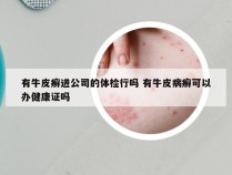 有牛皮癣进公司的体检行吗 有牛皮病癣可以办健康证吗