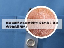 银屑病用他克莫司软膏停用后更厉害了 银屑病用他克莫司好了