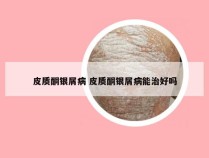 皮质酮银屑病 皮质酮银屑病能治好吗