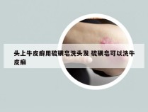 头上牛皮癣用硫磺皂洗头发 硫磺皂可以洗牛皮癣