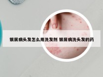 银屑病头发怎么用洗发剂 银屑病洗头发的药