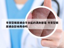 寻常型银屑病会不会起的满身都是 寻常型银屑病会影响寿命吗