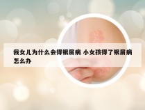 我女儿为什么会得银屑病 小女孩得了银屑病怎么办