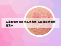 头发有银屑病用什么洗发水 头部银屑病推荐洗发水