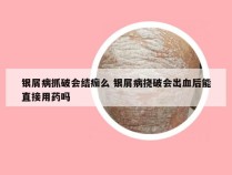 银屑病抓破会结痂么 银屑病挠破会出血后能直接用药吗