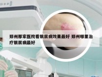 郑州那家医院看银屑病效果最好 郑州哪里治疗银屑病最好