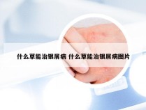 什么草能治银屑病 什么草能治银屑病图片