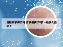 皮肤癣都传染吗 皮肤癣传染吗?一般多久感染上