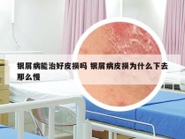银屑病能治好皮损吗 银屑病皮损为什么下去那么慢