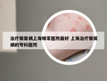 治疗银屑病上海哪家医院最好 上海治疗银屑病的专科医院