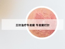 三针治疗牛皮廨 牛皮廨打针