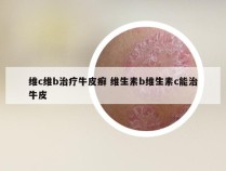 维c维b治疗牛皮癣 维生素b维生素c能治牛皮