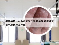 银屑病第一次治愈复发几率很大吗 银屑病复发一次比一次严重