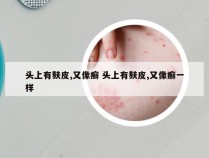 头上有麸皮,又像癣 头上有麸皮,又像癣一样