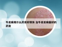 牛皮癣用什么药膏好得快 治牛皮皮癣最好的药膏