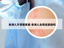 非洲人不得银屑病 非洲人会得皮肤癌吗