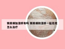 银屑病加湿疹有吗 银屑病和湿疹一起出现 怎么治疗