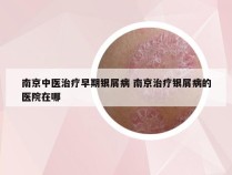 南京中医治疗早期银屑病 南京治疗银屑病的医院在哪