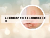 头上长银屑病的原因 头上长银屑病是什么原因