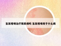 氢氯噻嗪治疗银屑病吗 氢氯噻嗪用于什么病