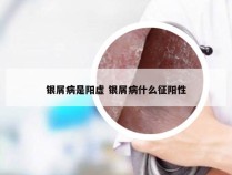 银屑病是阳虚 银屑病什么征阳性