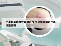 手上银屑病为什么消退慢 手上银屑病为什么消退慢呢