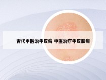 古代中医治牛皮癣 中医治疗牛皮肤癣