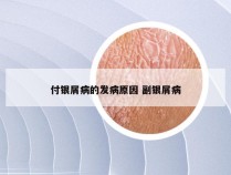 付银屑病的发病原因 副银屑病