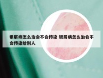 银屑病怎么治会不会传染 银屑病怎么治会不会传染给别人