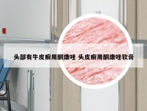 头部有牛皮癣用酮康唑 头皮癣用酮康唑软膏