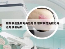 银屑病是免疫力高还是低 银屑病是免疫力高还是低引起的
