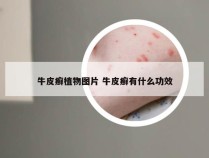 牛皮癣植物图片 牛皮癣有什么功效