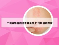 广州候银屑病逸青菜当赞 广州银屑病专家