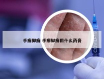 手癣脚癣 手癣脚癣用什么药膏