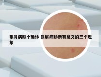 银屑病缺个确诊 银屑病诊断有意义的三个现象