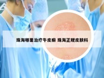 珠海哪里治疗牛皮癣 珠海正规皮肤科