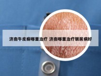 济南牛皮癣哪里治疗 济南哪里治疗银屑病好