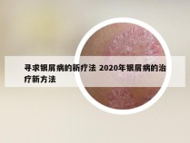 寻求银屑病的新疗法 2020年银屑病的治疗新方法