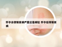 怀孕会使银屑病严重还是缓轻 怀孕后得银屑病