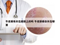 牛皮癣有长在肩膀上的吗 牛皮肤癣会长在哪里