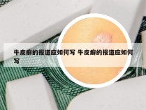 牛皮癣的报道应如何写 牛皮癣的报道应如何写