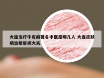 大连治疗牛皮癣著名中医是哪几人 大连皮肤病治银屑病大夫