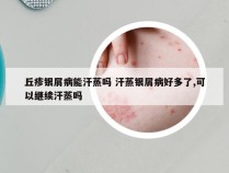 丘疹银屑病能汗蒸吗 汗蒸银屑病好多了,可以继续汗蒸吗