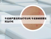 牛皮癣严重住院治疗可以吗 牛皮肤癣需要住院治疗吗